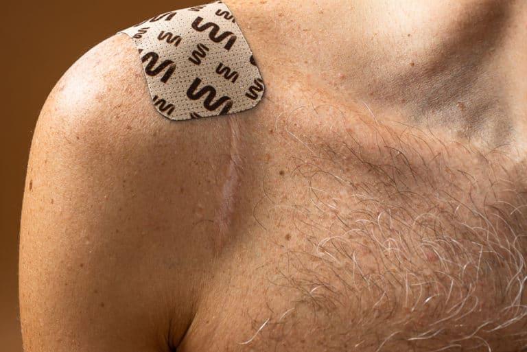 Comment faire partir une cicatrice de bouton