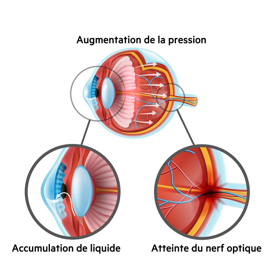 Comment faire baisser la tension oculaire naturellement