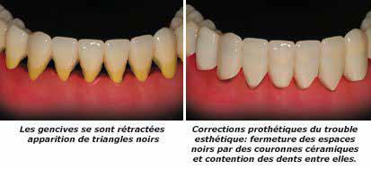 Comment faire dégonfler la gencive