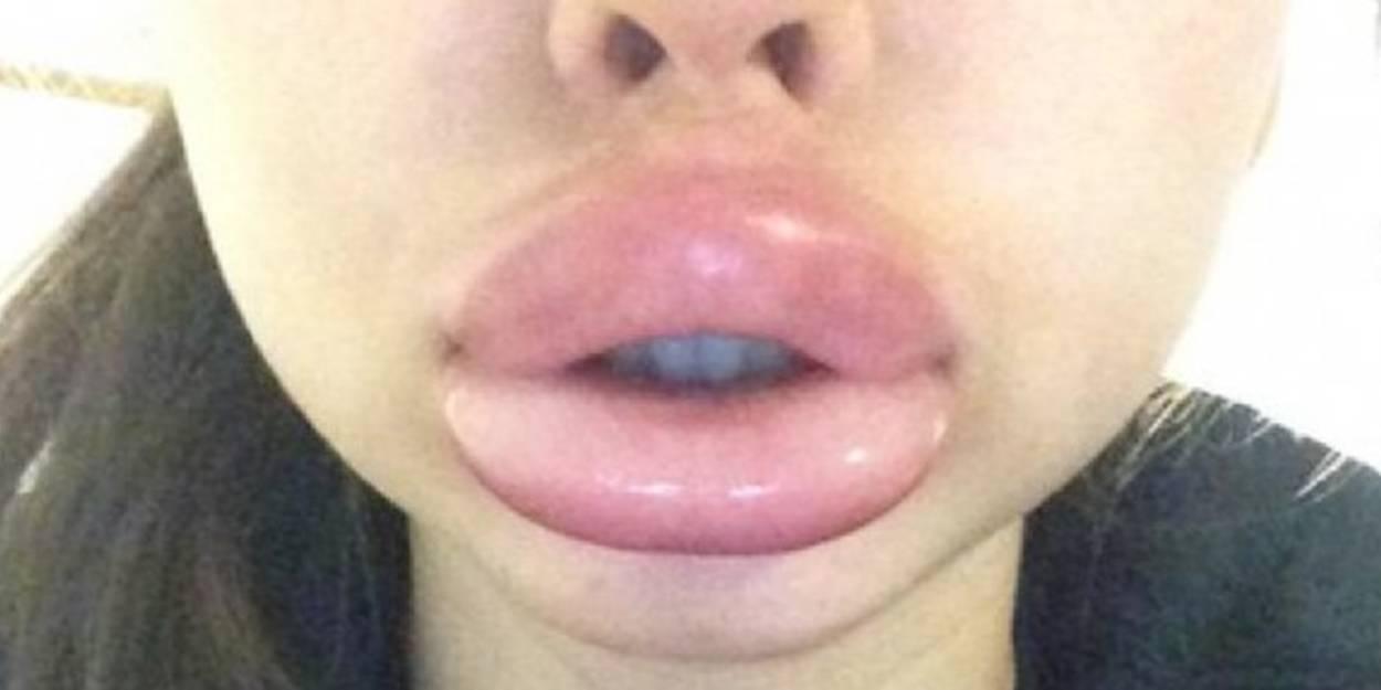 Les remèdes maison pour apaiser les lèvres enflées