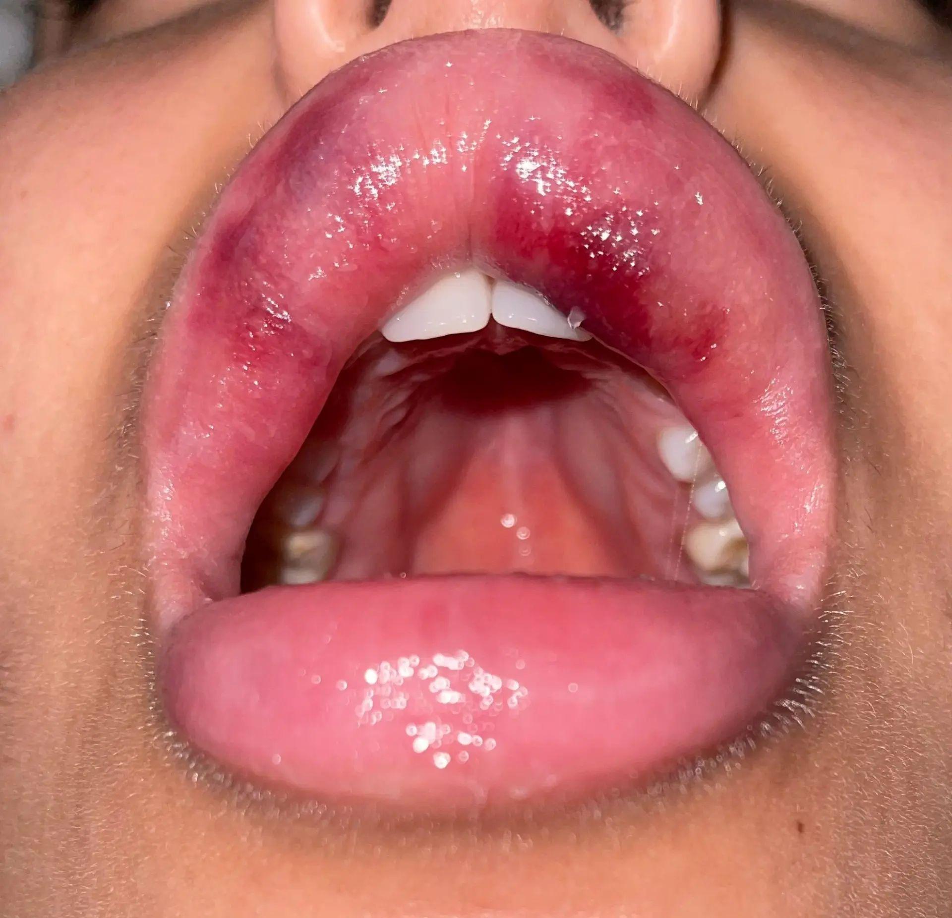 Comment faire dégonfler une lèvre