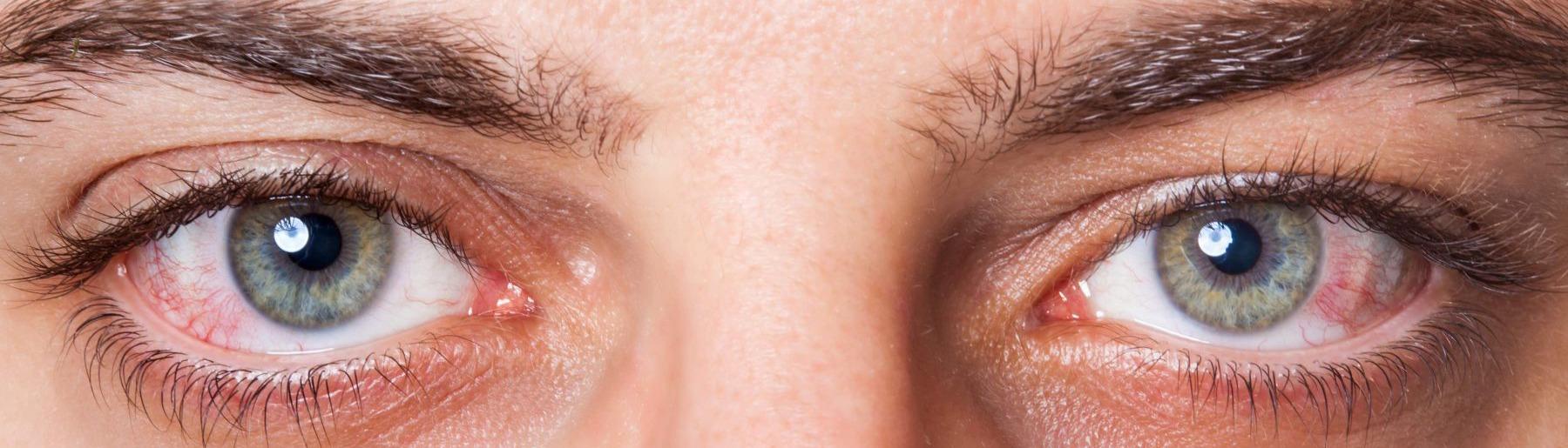 Comment faire baisser la tension oculaire naturellement