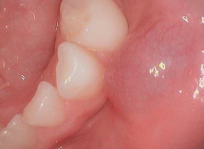 Comprendre les causes du gonflement des gencives