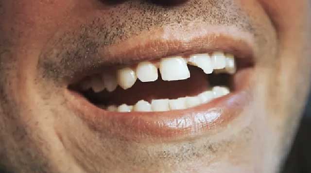 Video Comment Faire Tomber Une Dent Sans Avoir Mal