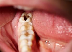 Prévenir les maux de dents : conseils pour un quotidien sans tracas