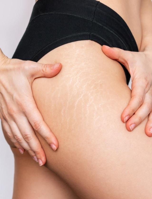 Les causes des vergetures : comprendre pour mieux agir