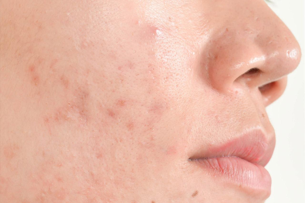 Comment faire partir les cicatrices d’acné