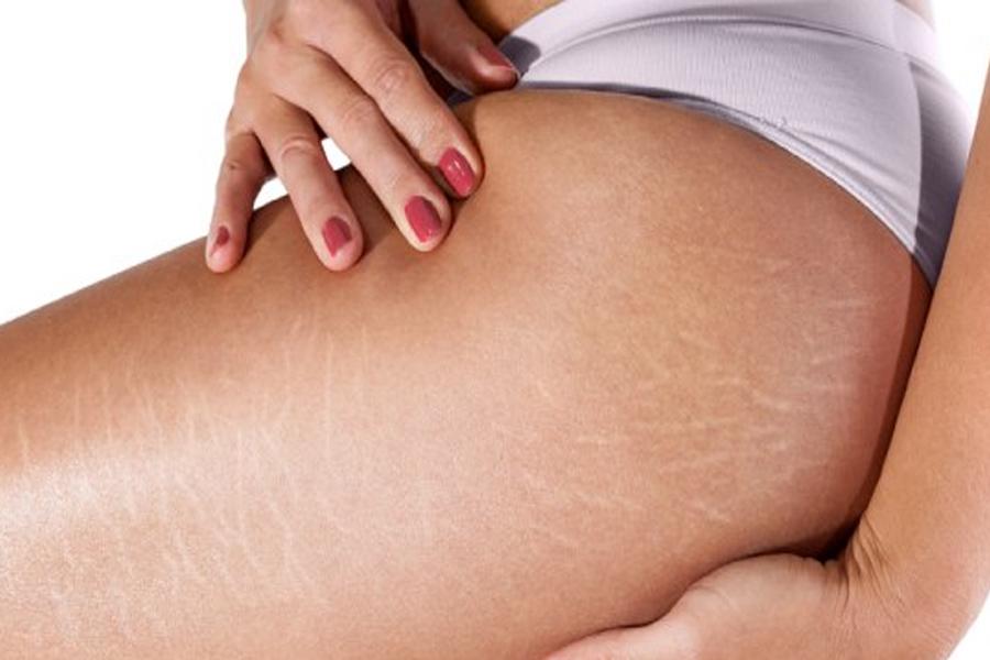 Comment faire partir des vergetures