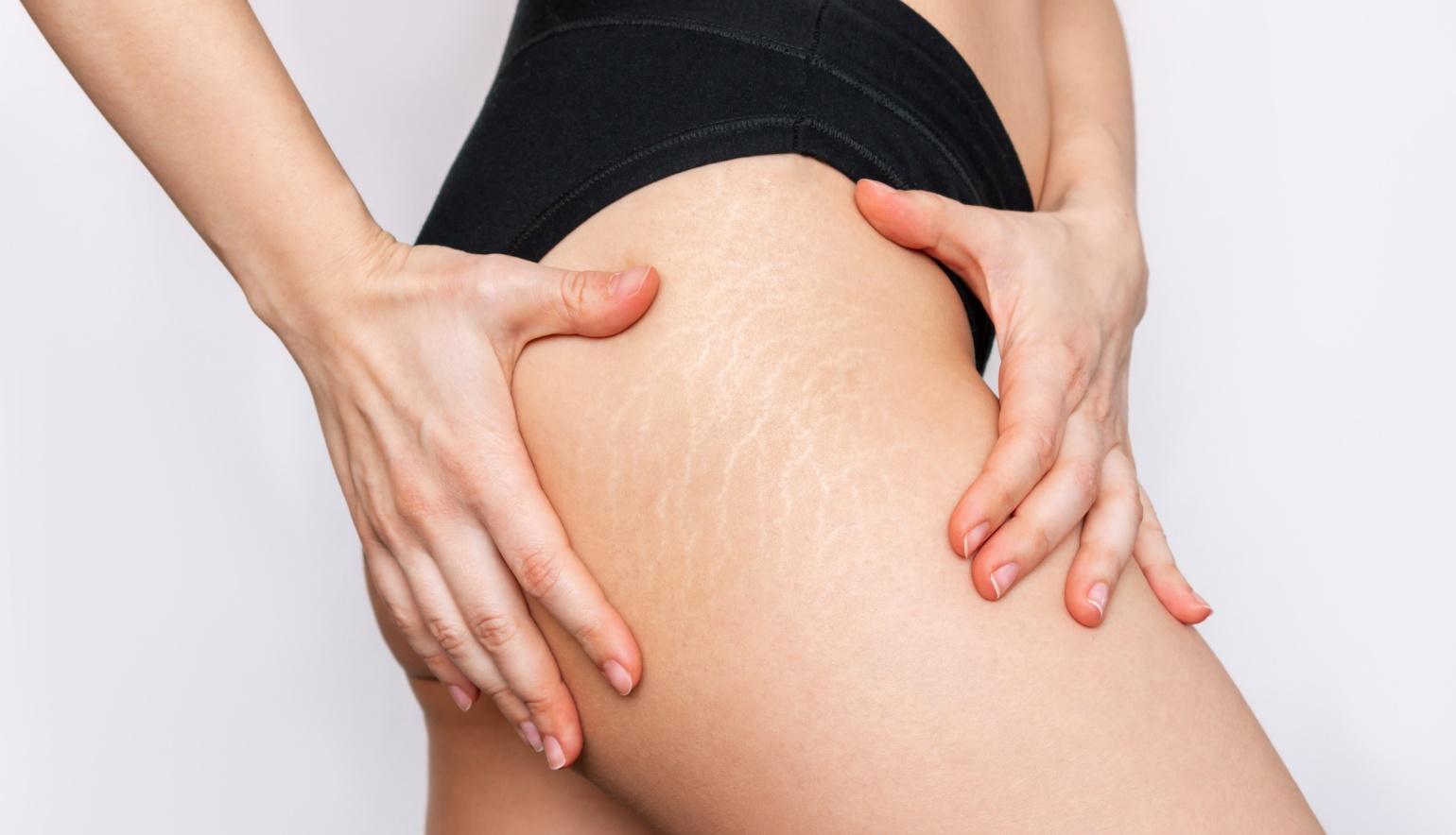 Comment faire disparaître les vergetures