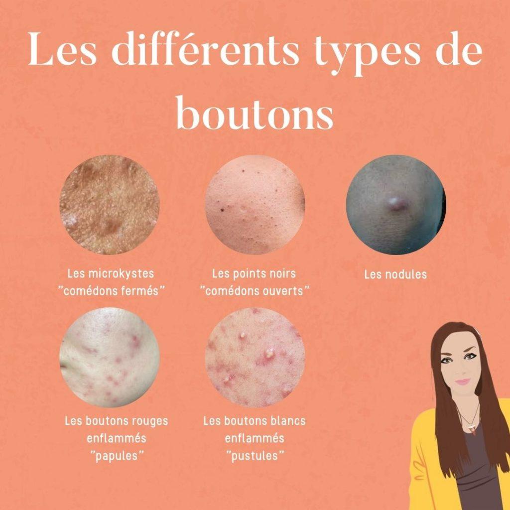 Comprendre les causes des boutons pour mieux les prévenir