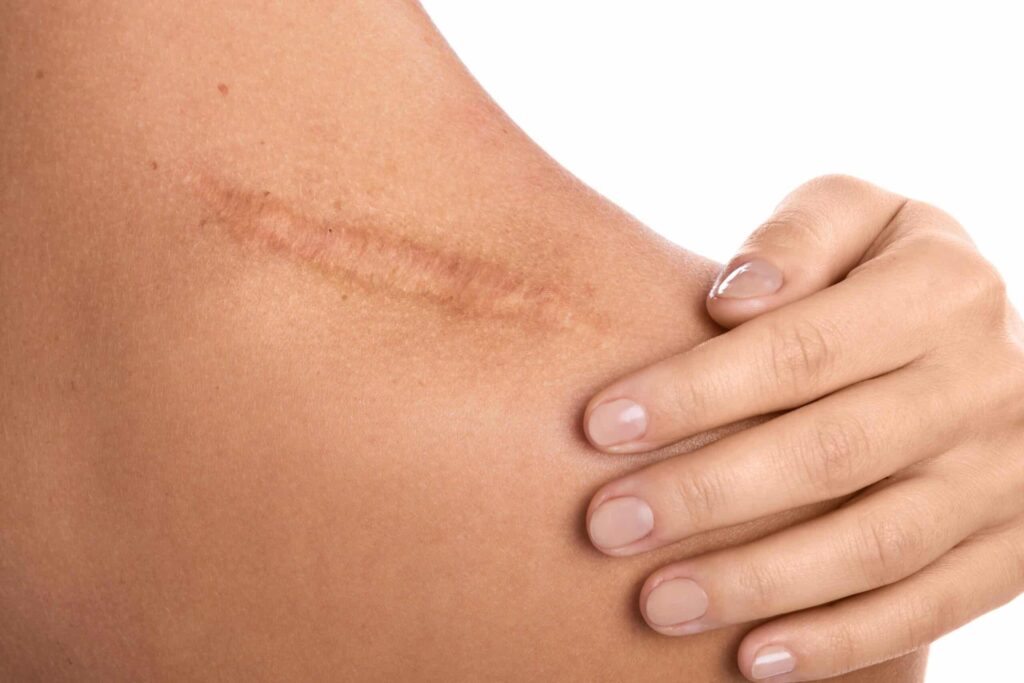 Comment faire disparaitre des cicatrices - On Fait Comment