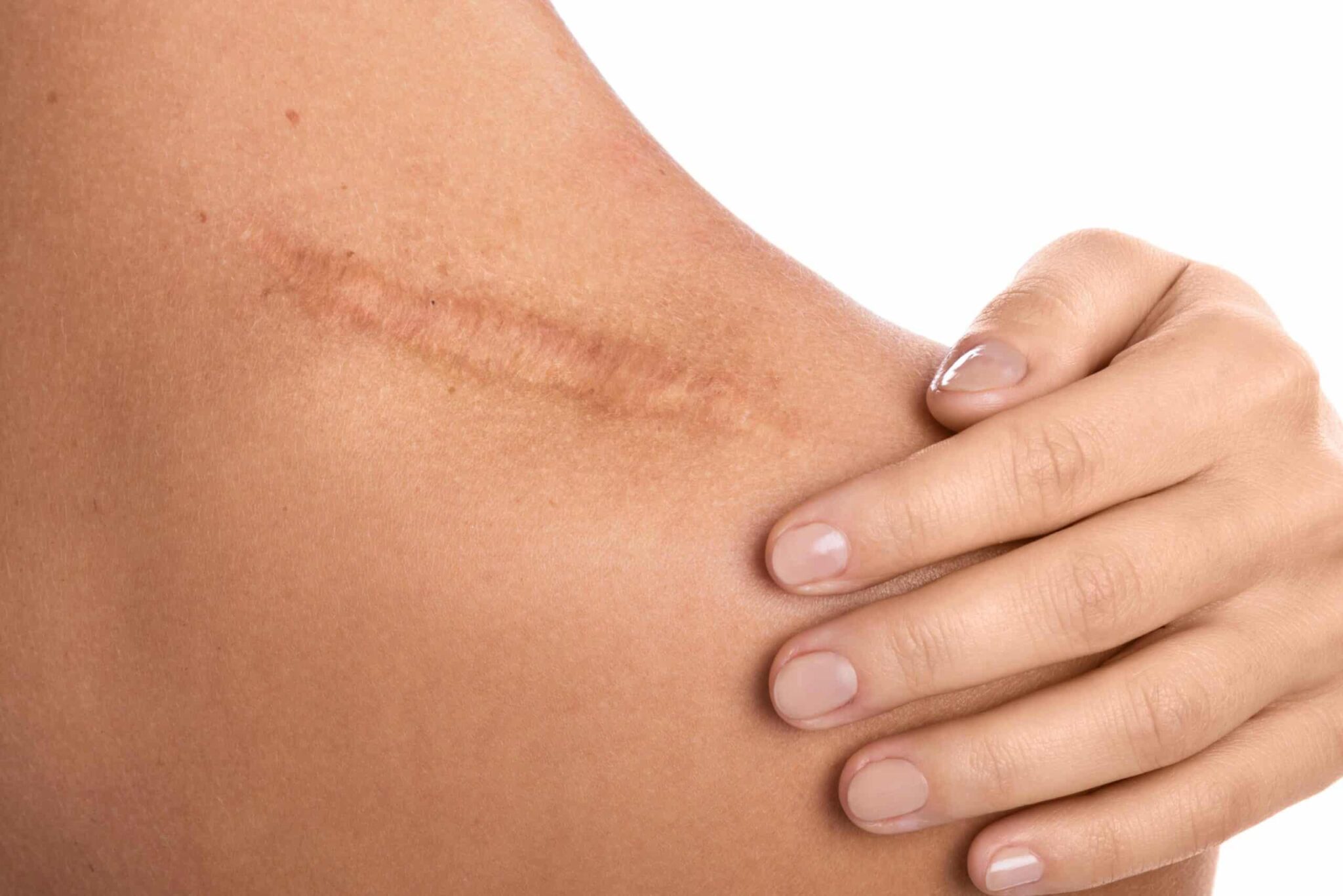 Comment faire disparaitre des cicatrices - On Fait Comment