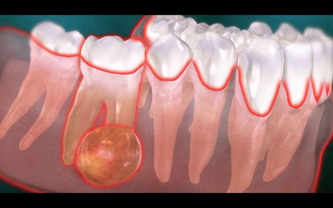 Prévenir les abcès dentaires : bons gestes au quotidien