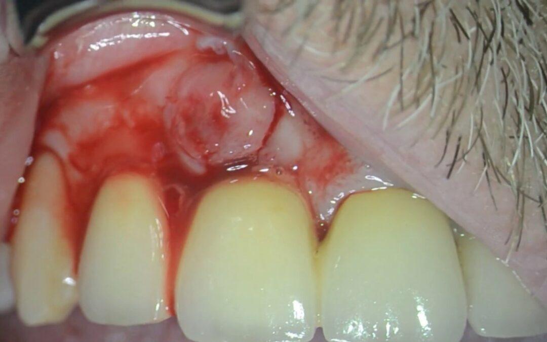 Comment faire murir un abces dentaire