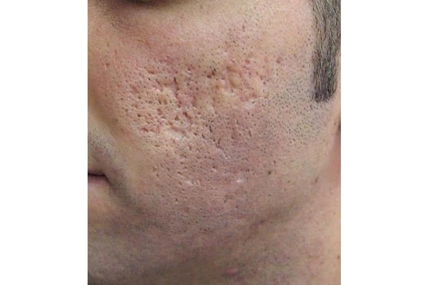 Les secrets de la peau éclatante : comprendre les cicatrices dacné