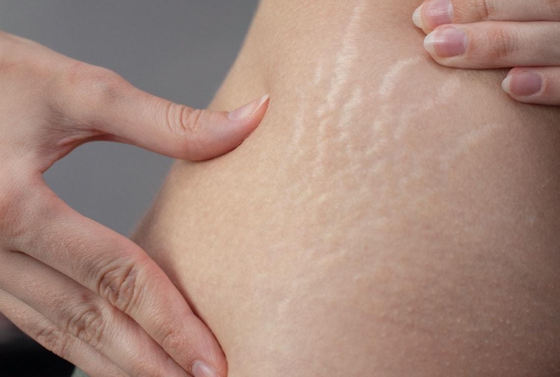 Les meilleures astuces naturelles pour atténuer les vergetures