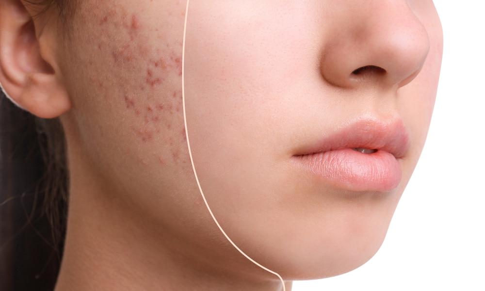 Les soins de la peau : choisir les bons produits pour atténuer les cicatrices