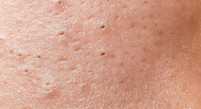 Prévenir l’apparition des points noirs : Astuces au quotidien