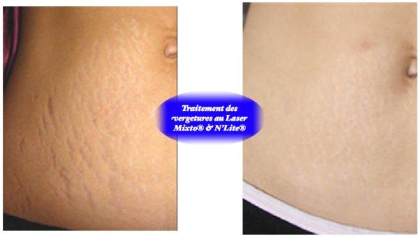 Comment faire partir vergeture