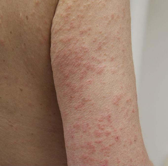 Comment faire disparaître les boutons d’allergie au soleil