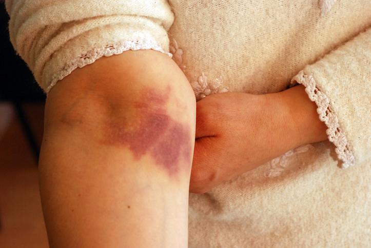 Comment faire disparaître une cicatrice de brûlure ancienne