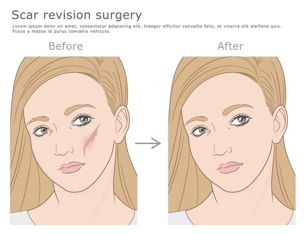 Comment faire ‌disparaître une cicatrice au visage