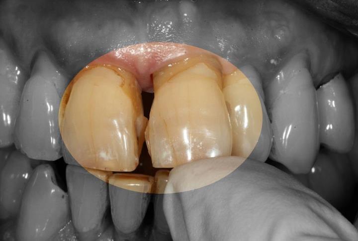 Comprendre pourquoi ta dent bouge : les causes à⁤ connaître