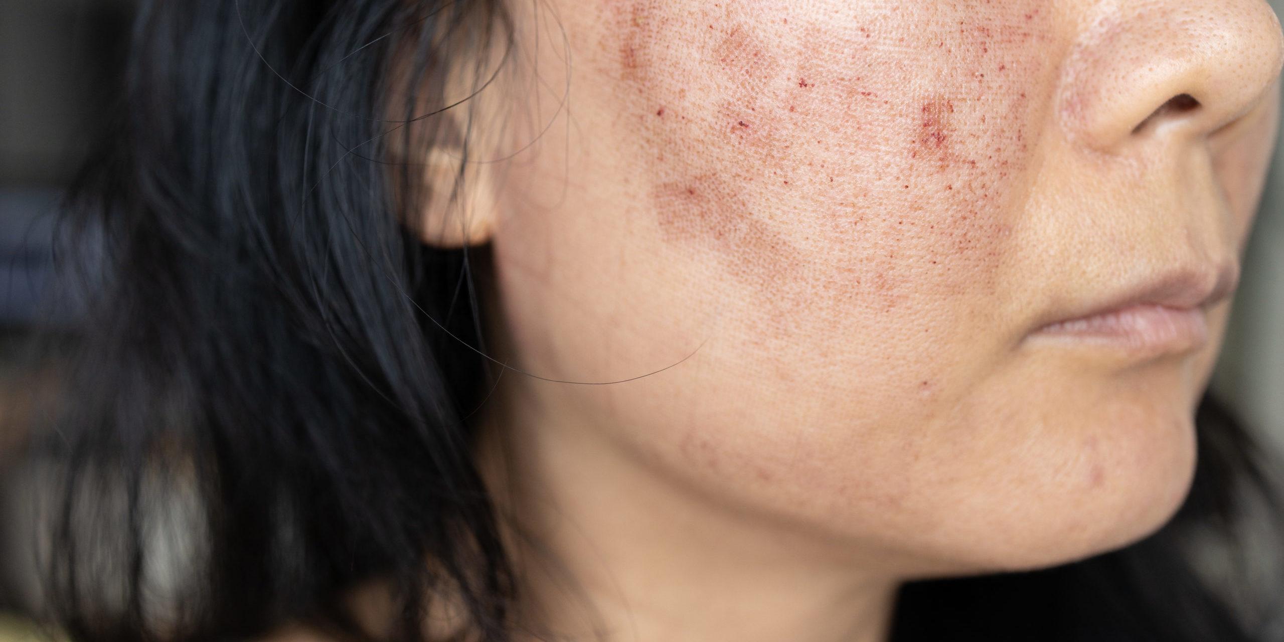 Prévenir l’apparition de nouvelles cicatrices : conseils pratiques