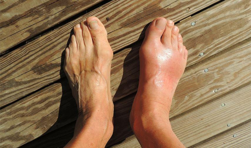 Comprendre les Causes du Gonflement des​ Pieds