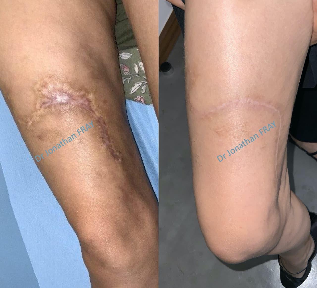 Comment faire disparaître une cicatrice de brûlure ancienne