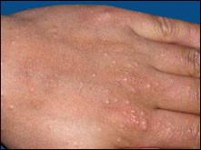 Conseils pratiques pour prévenir lapparition des boutons