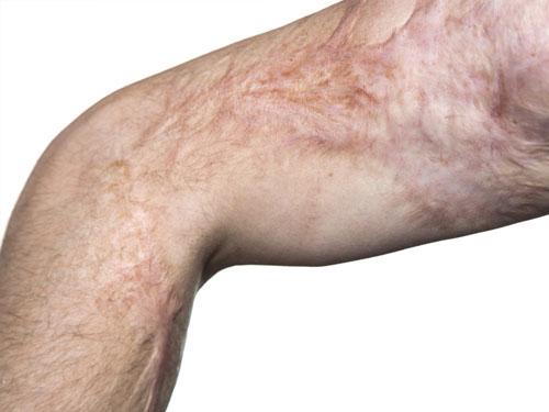 Comprendre la cicatrice de brûlure et son évolution