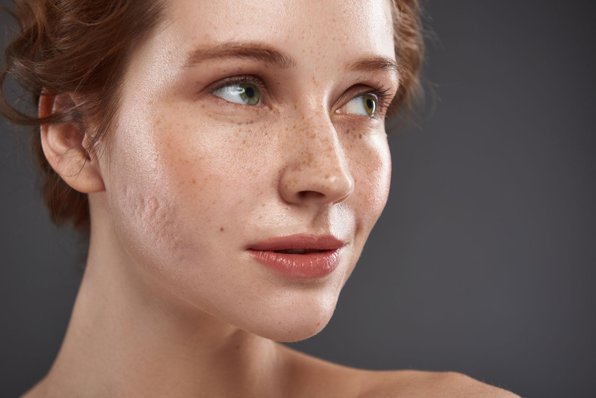 Comprendre les cicatrices⁣ du​ visage ‍et leur formation