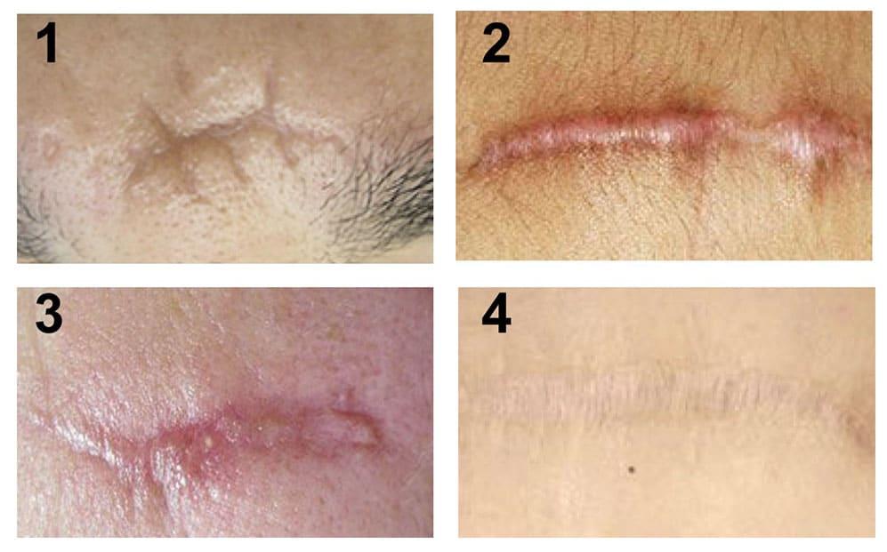 Comment faire partir les cicatrices