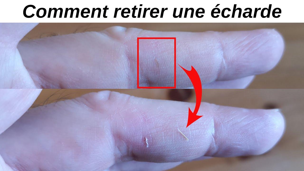 Comment faire sortir une écharde