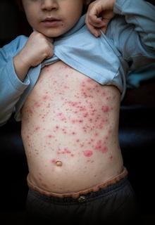 Comment faire sécher les boutons de varicelle rapidement