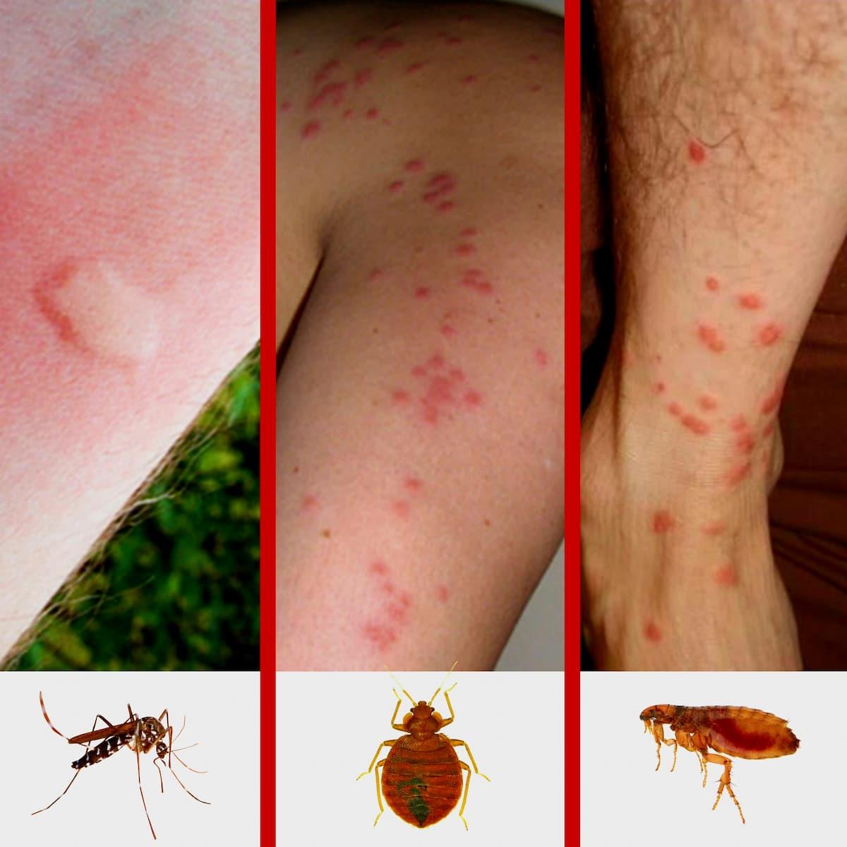 Comment faire disparaître un bouton de moustique