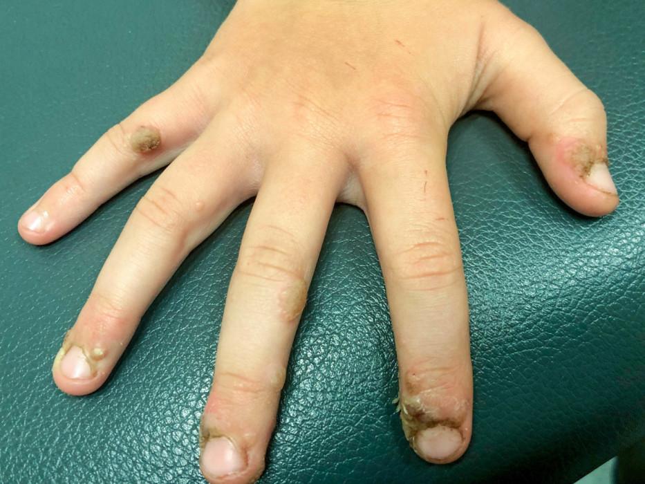 Comment faire disparaitre une verrue