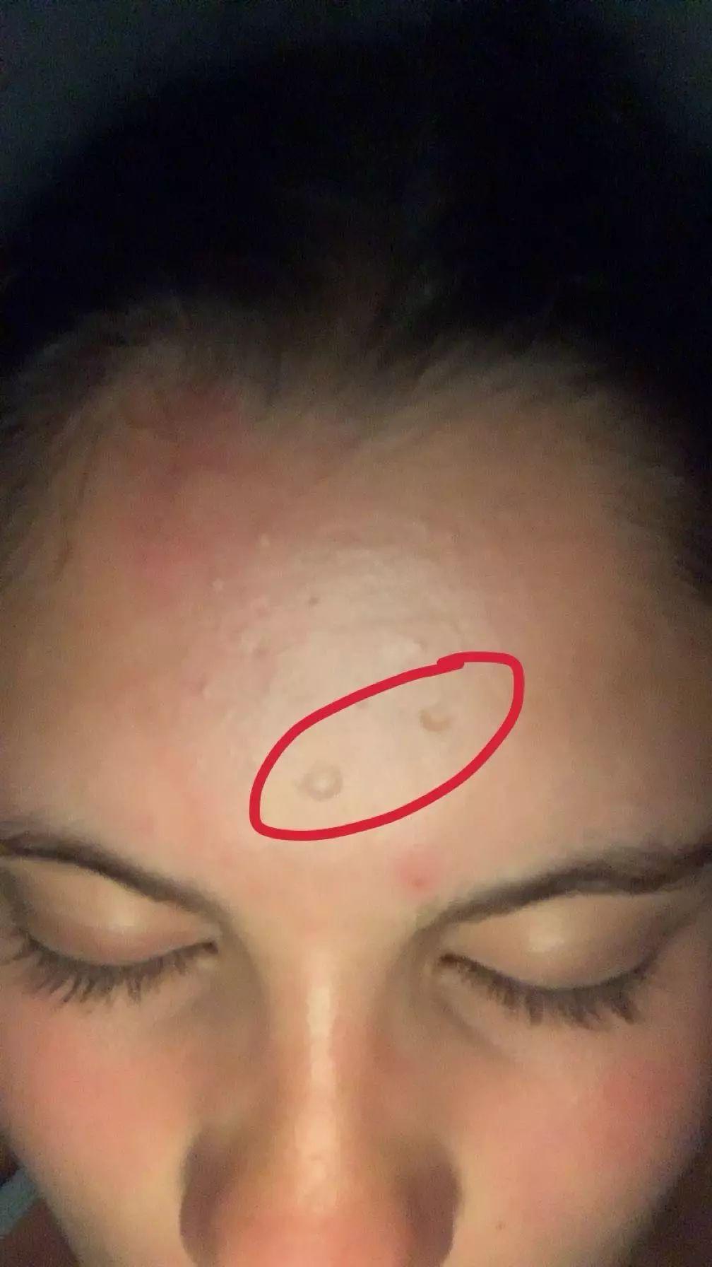 Prévenir les cicatrices : conseils pour une peau saine après la ‍varicelle