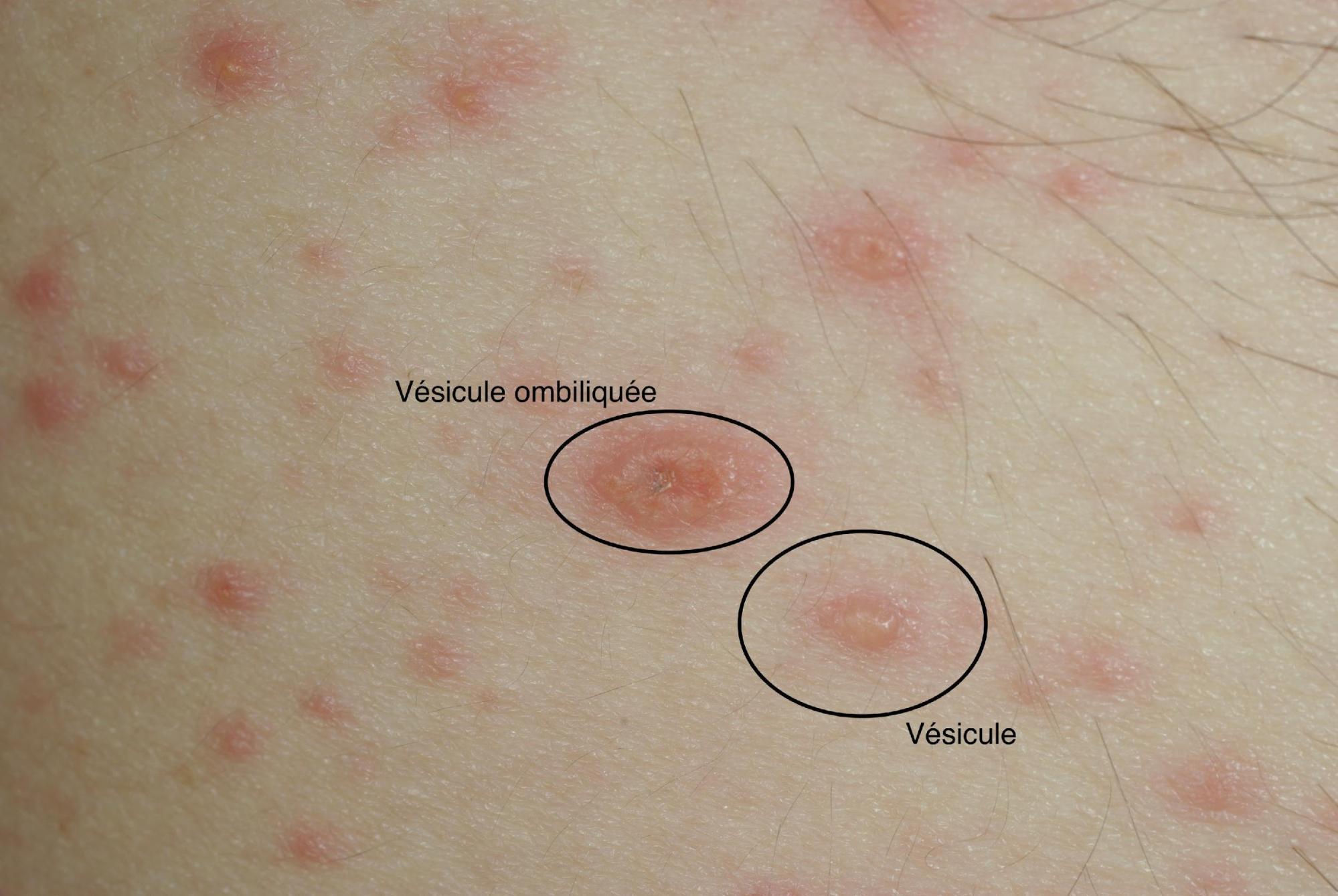 Les meilleures astuces pour⁣ assécher rapidement les ⁢boutons de varicelle