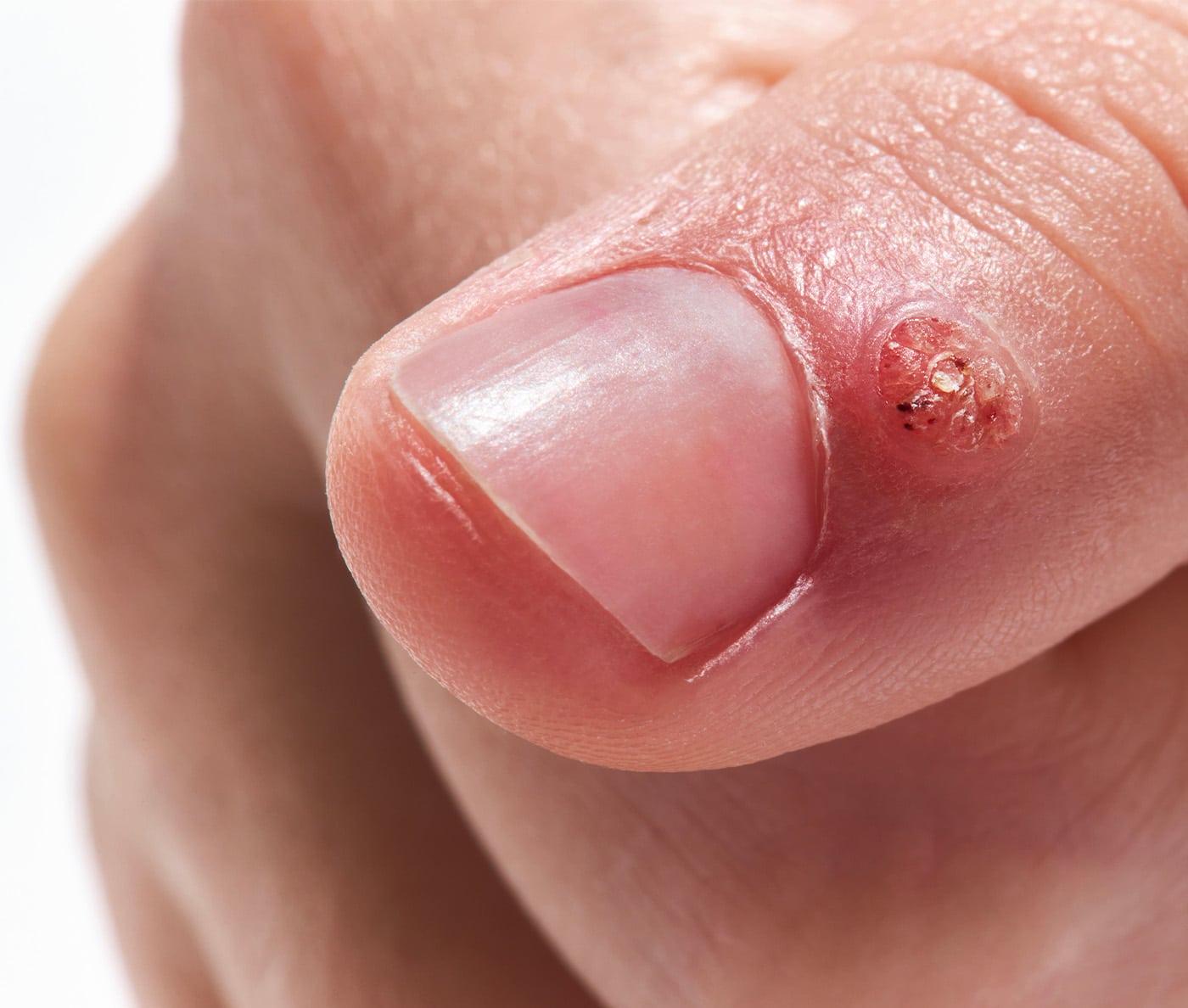 Les différentes types de verrues : comprendre pour mieux agir