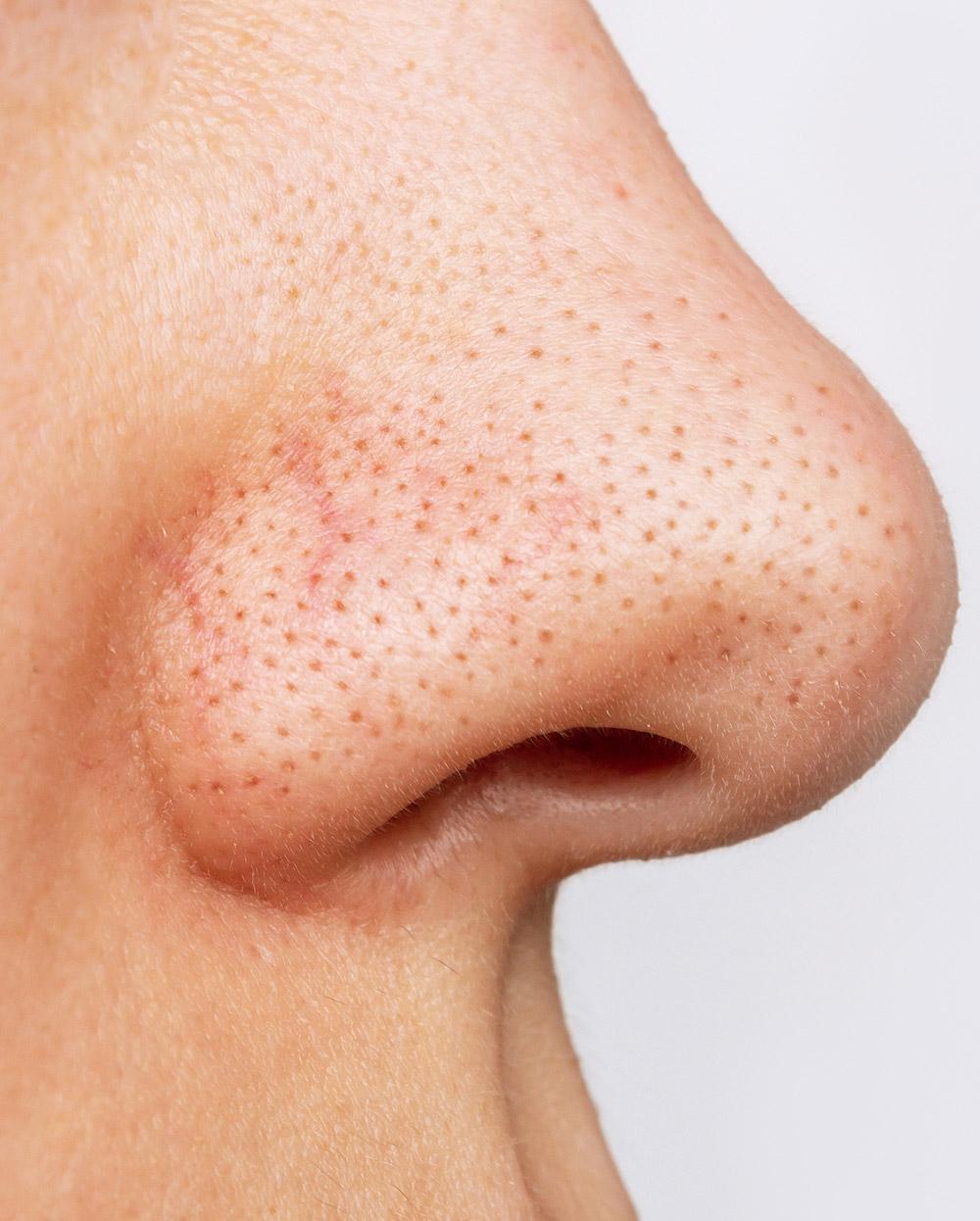 Comment faire partir les points noirs