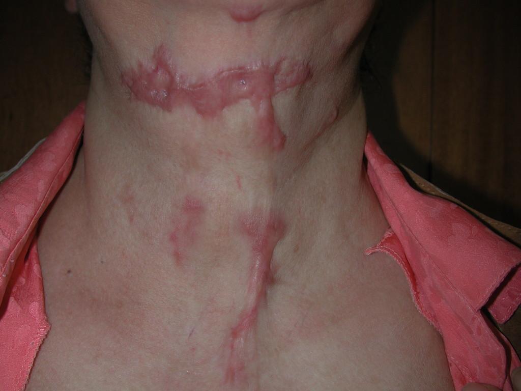 Comment faire partir une cicatrice