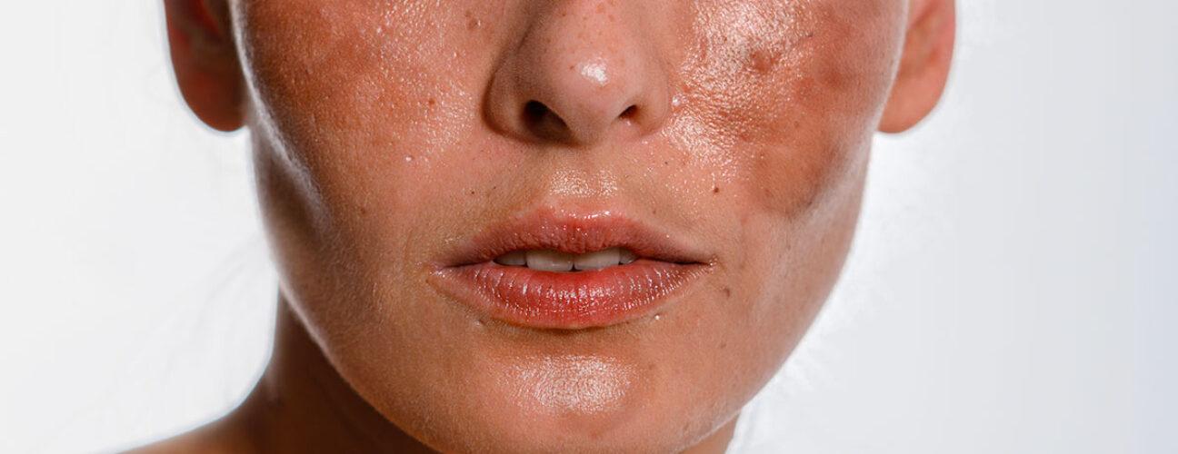 Comment faire disparaitre les taches brunes sur le visage