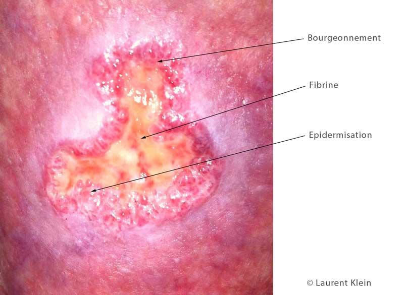 Comment faire disparaître la fibrine