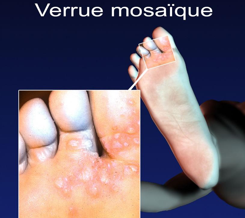 Prévention des verrues : astuces pour éviter leur apparition