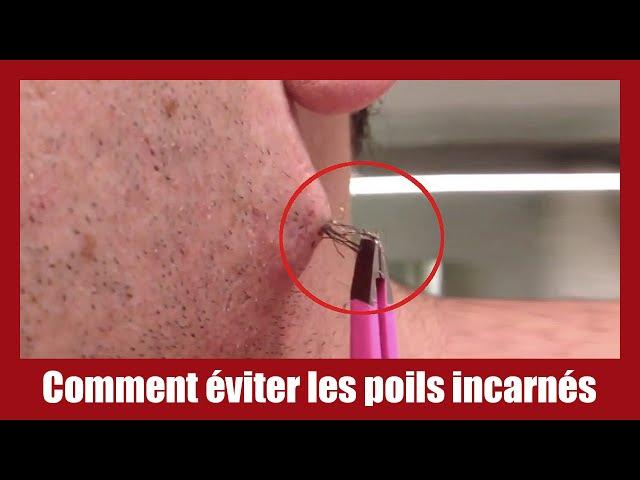 Comprendre‌ les poils incarnés⁢ : Un aperçu de⁤ ce phénomène dérangeant