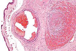 Comment faire disparaître la fibrine