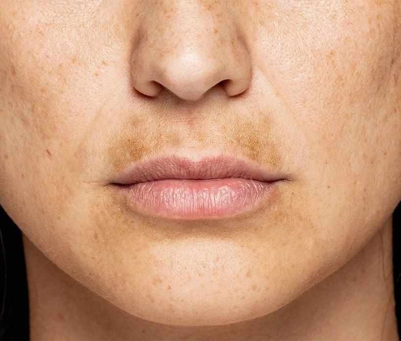 Les causes des taches brunes : comprendre pour mieux agir