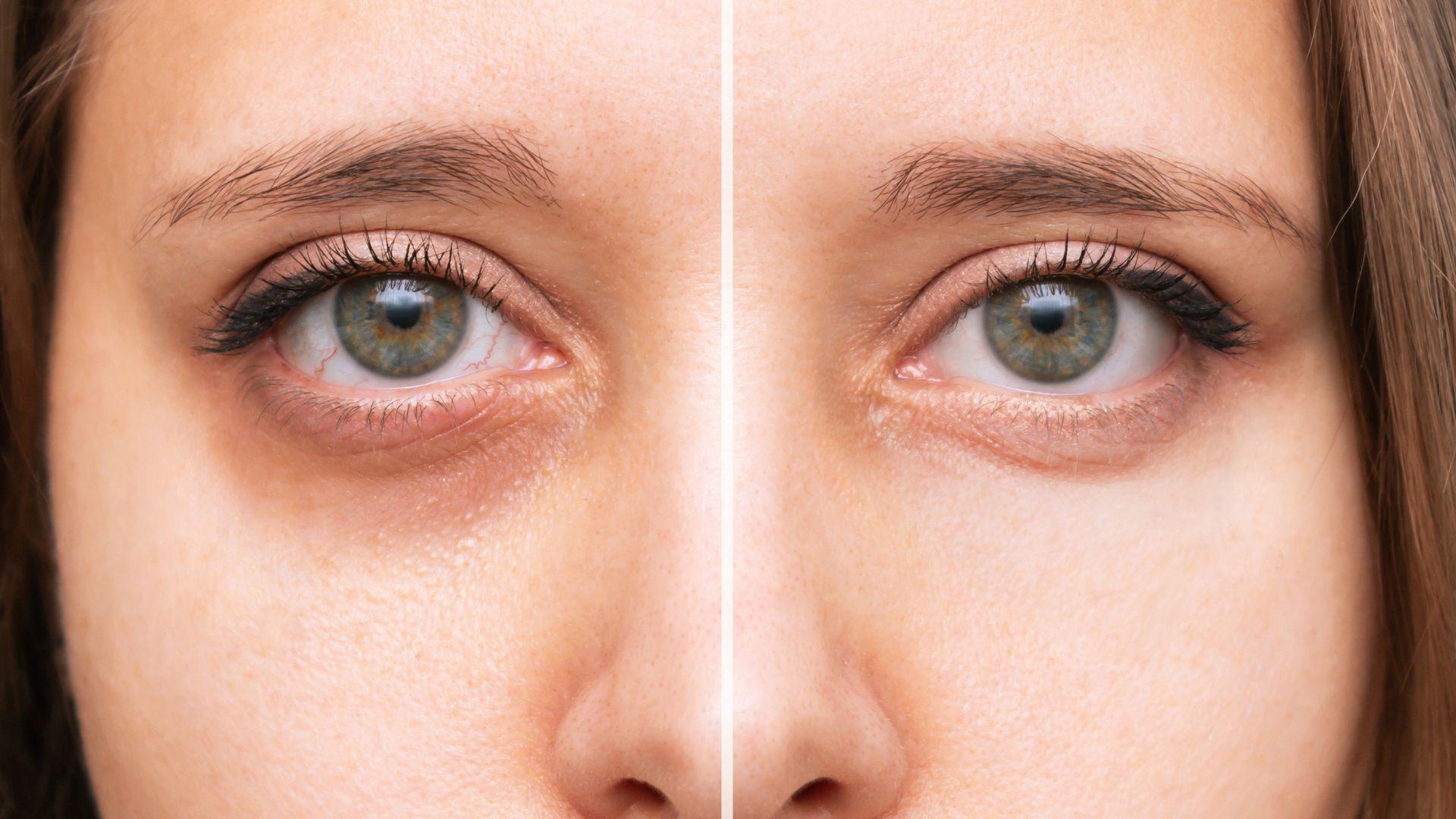 Les ⁢astuces ⁤naturelles⁤ pour chasser les⁢ cernes